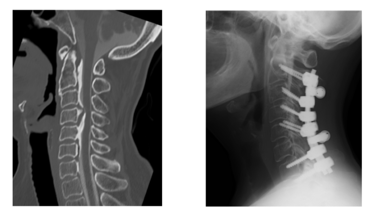 Ossification of the Posterior Longitudinal Ligament (OPLL), Yellow Ligament Ossification