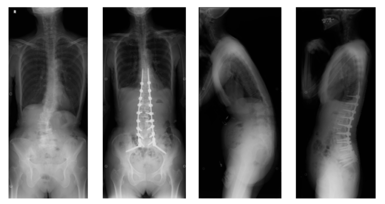 Adolescent Idiopathic Scoliosis