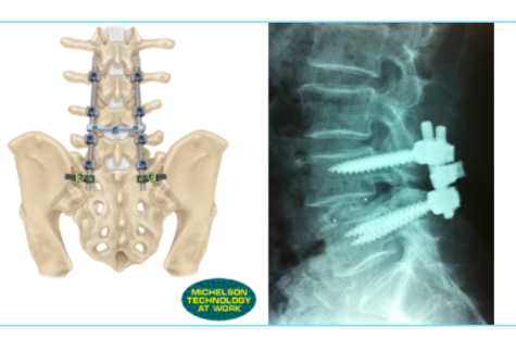 Lumbar Degenerative Spondylolisthesis