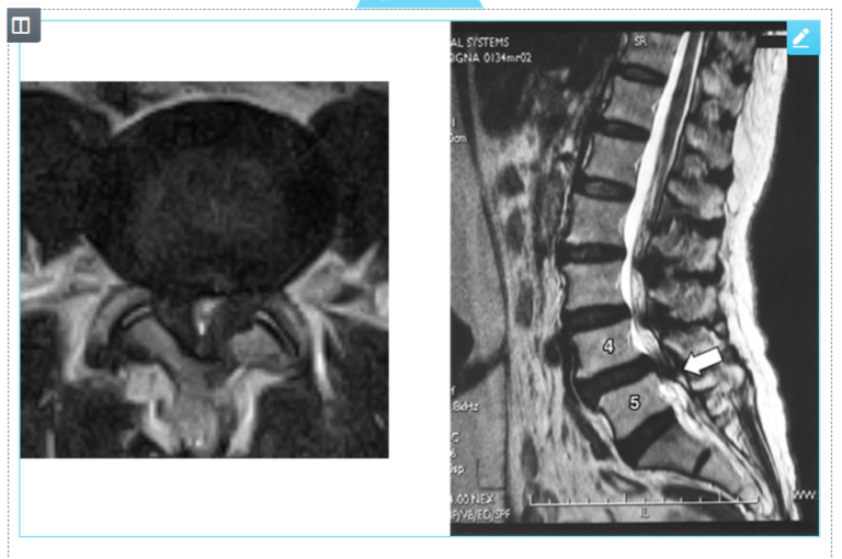 Lumbar Spinal Stenosis