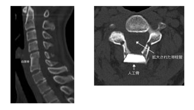 Cervical Spondylotic Radiculopathy and Myelopathy (Cervical Myelopathy)