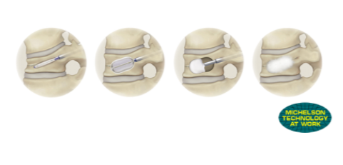 Osteoporotic Vertebral Compression Fracture