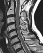 頚椎症性脊髄症1