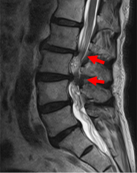 腰部脊柱管狭窄症1-1a