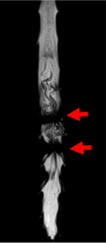 腰部脊柱管狭窄症1-2a