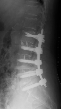 腰部脊柱管狭窄症3-1