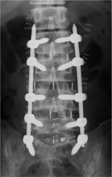 腰部脊柱管狭窄症3-2